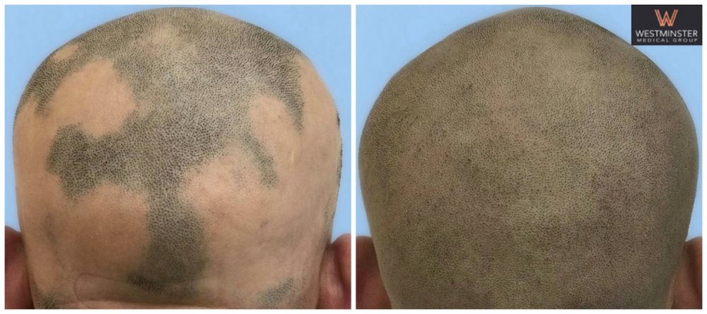 Alopecia SMP.jpg