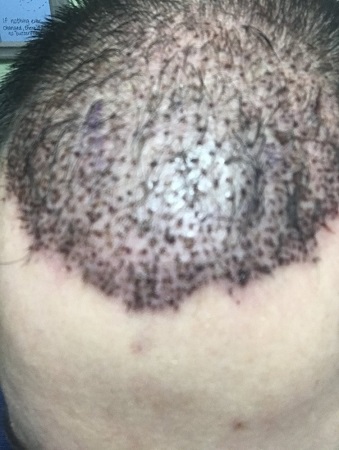 bad hair transplant 1.jpeg