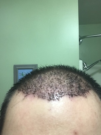 bad hair transplant 2.jpeg