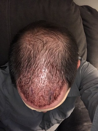 Bad hair transplant.jpeg