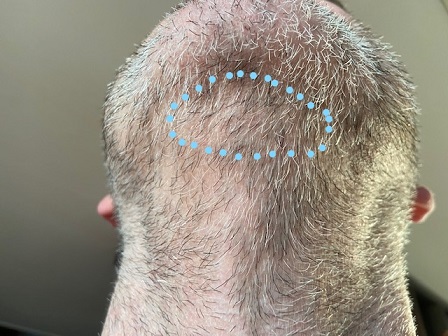 Beard FUE Donor extractions._LI.jpg