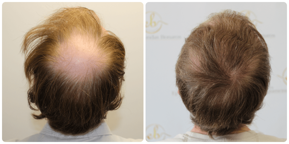 Dr Bonaros, Glasgow, UK / Hair Transplant Result Crown Area / 2016 FUE