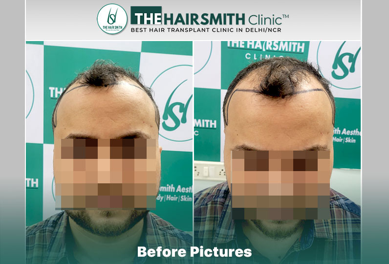 Before Hair Transplant HS 834- The Hairsmith Clinic Delhi India - #hairtransplant.JPG