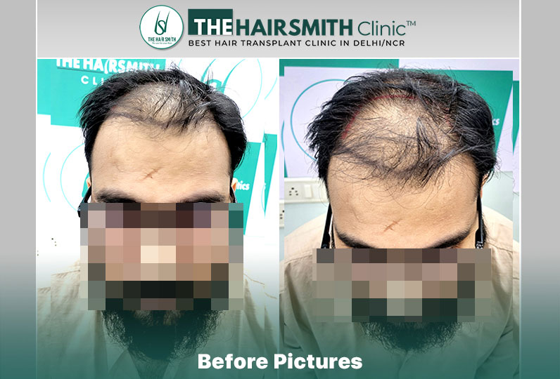 Before Hair Transplant HS 838- The Hairsmith Clinic Delhi India - #hairtransplant #hairlosssta...jpg