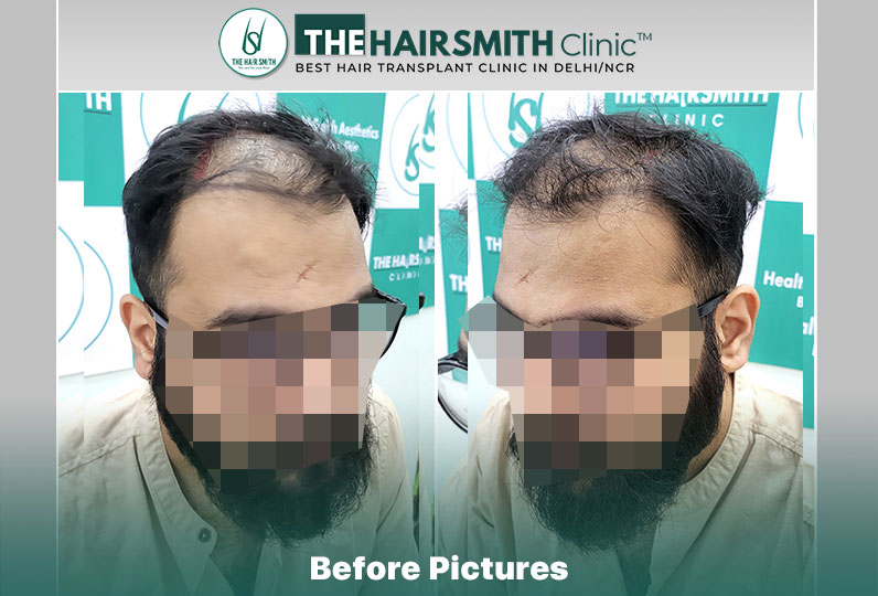 Before Hair Transplant HS 838- The Hairsmith Clinic Delhi India - #hairtransplant #norwoodstage5.jpg