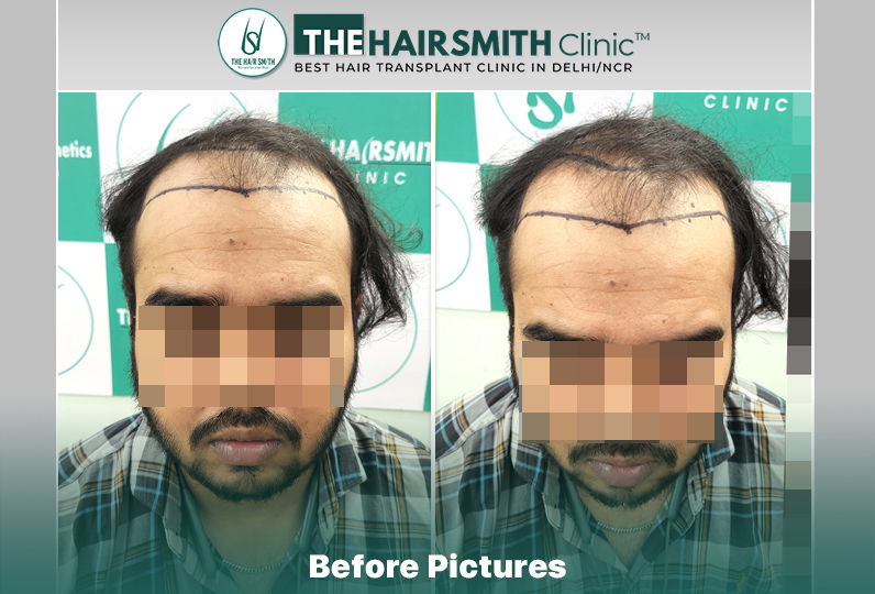 Before Hair Transplant HS 840- The Hairsmith Clinic Delhi India #HairTransplant.JPG