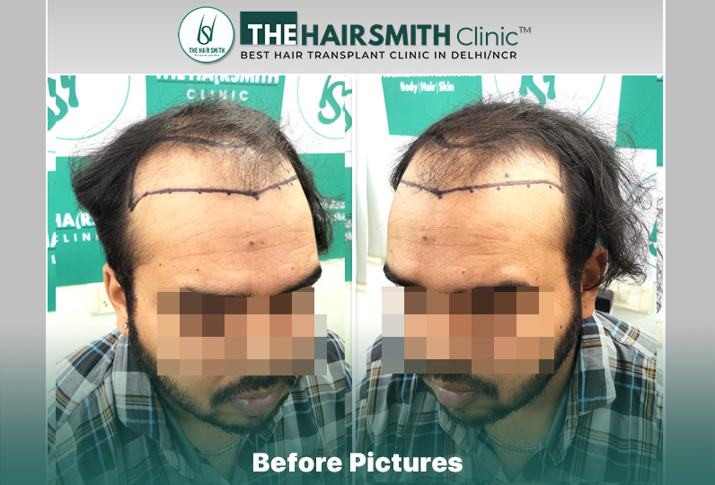 Before Hair Transplant HS 840- The Hairsmith Clinic Delhi India #HairTransplant #URFUEHairTran...JPG