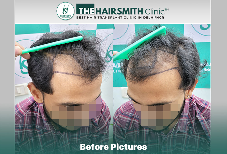 Before Hair Transplant HS 845- The Hairsmith Clinic Delhi India - #hairtransplant #hairregrowth.JPG