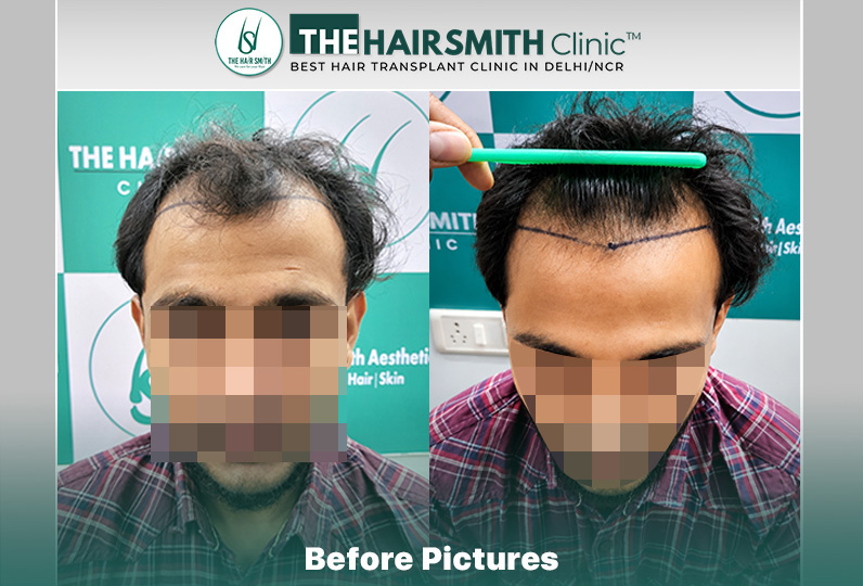 Before Hair Transplant HS 845- The Hairsmith Clinic Delhi India - #hairtransplant.JPG