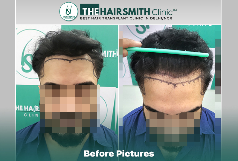 Before Hair Transplant HS846- The Hairsmith Clinic Delhi India #HairTransplant.JPG