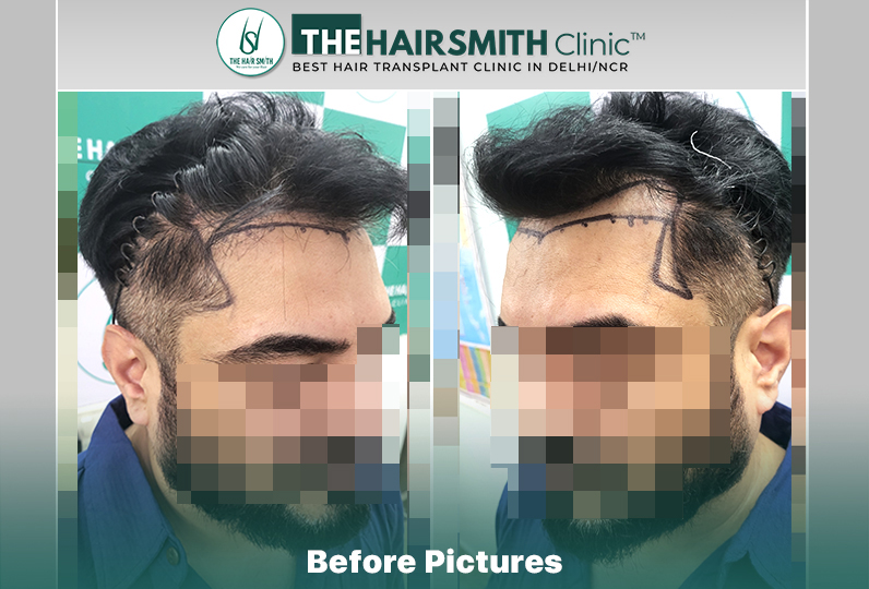Before Hair Transplant HS846 - The Hairsmith Clinic Delhi India #HairTransplant #URFUEHairTran...JPG