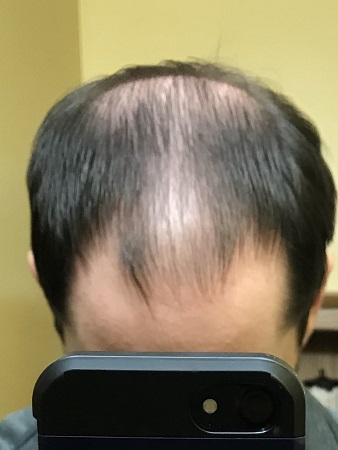 before hair transplant.jpeg