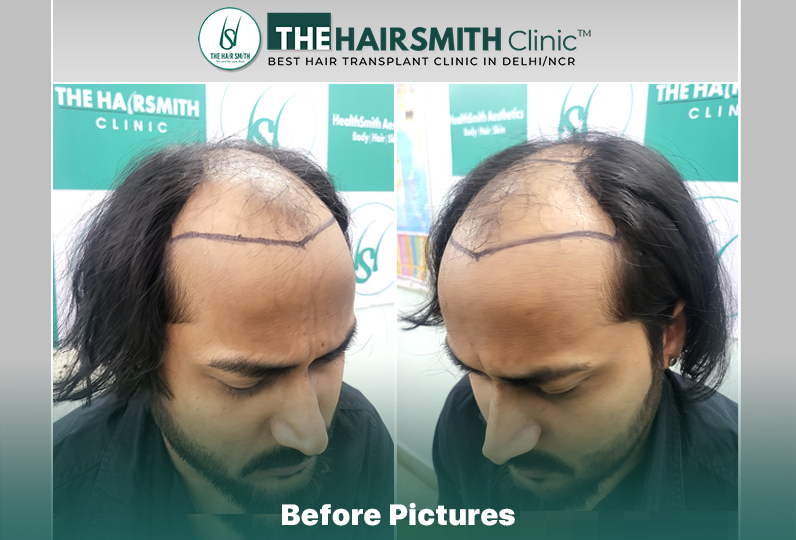 before hair transplant picture - the hairsmith clinci delhi india.jpg
