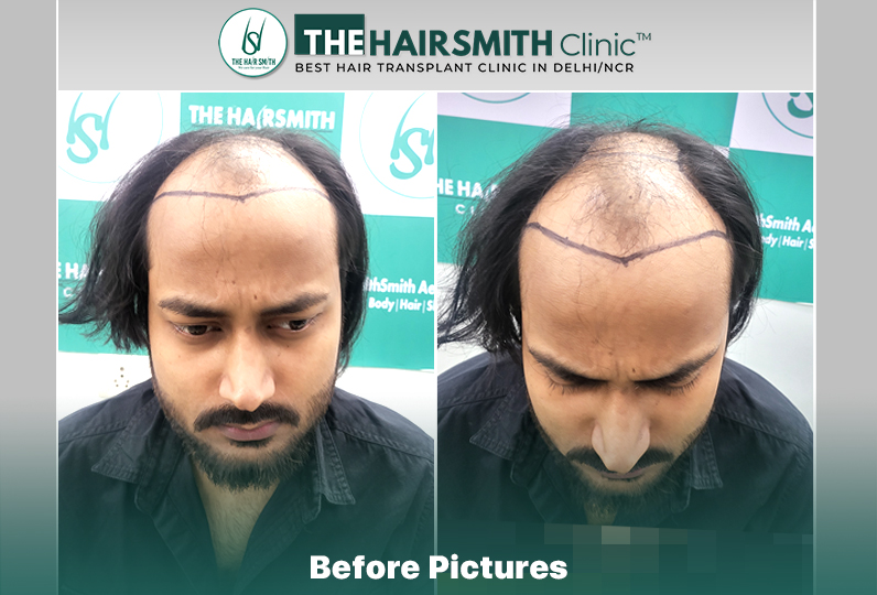before hair transplant picture - the hairsmith clinci delhi.jpg