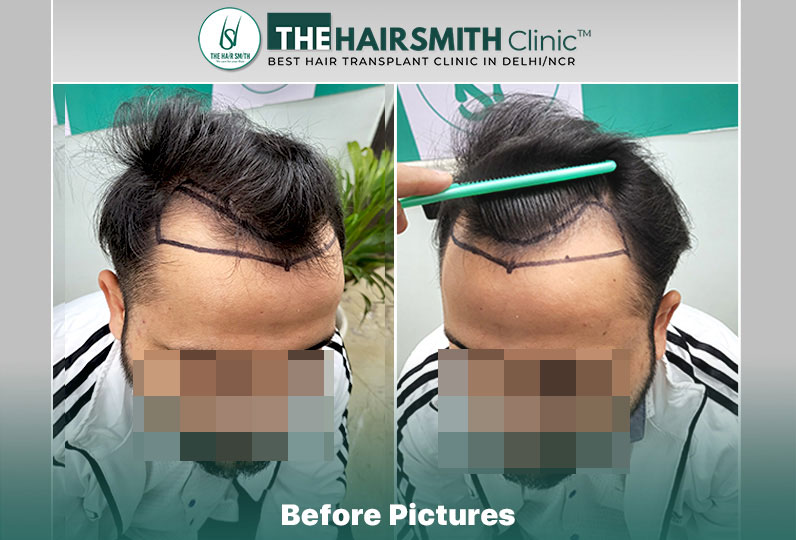 Before Hair Transplant - The HairSmith Clinic Delhi India.jpg