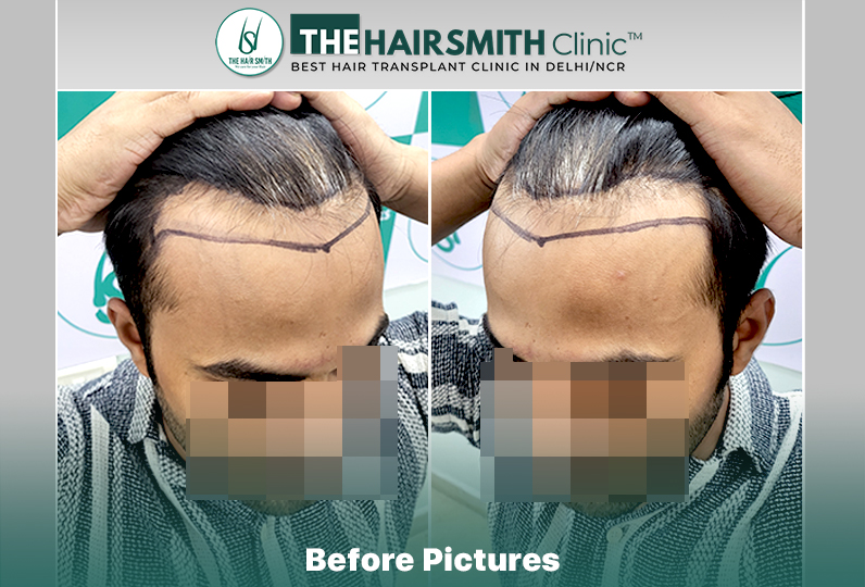 Before Hair Transplant - The HairSmith Clinic Delhi India.jpg