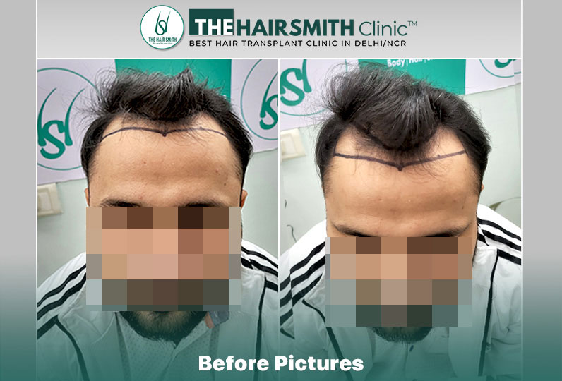 Before Hair Transplant - The Hairsmith Clinic.jpg