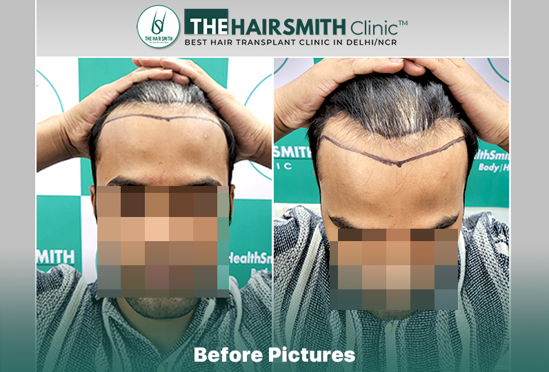 Before Hair Transplant - The Hairsmith Clinic.jpg