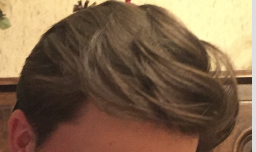 before hairloss at 18.png
