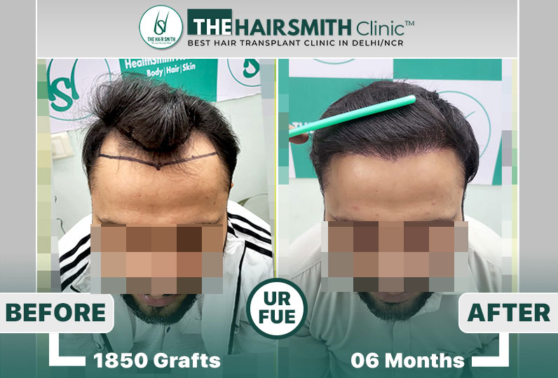 best hair transplant result.jpg