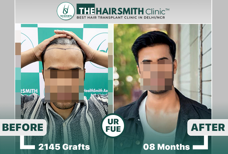 best hair transplant result - the hairsmith clinic.jpg