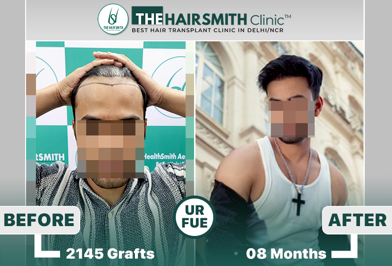best hair transplant results in delhi - the hairsmith clinic.jpg