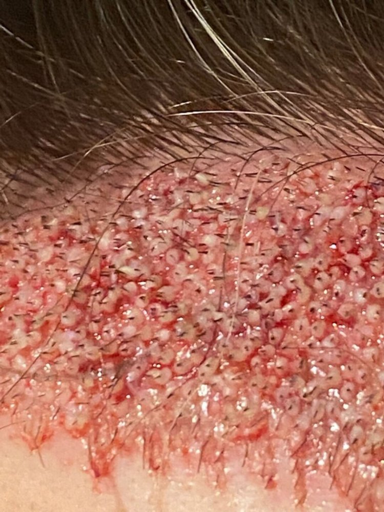 BHR Brussels hair transplant10.jpeg