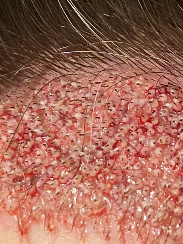 BHR Brussels hair transplant11.jpeg