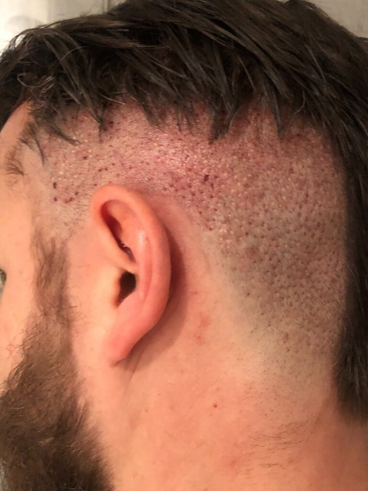 BHR Brussels hair transplant12.jpeg