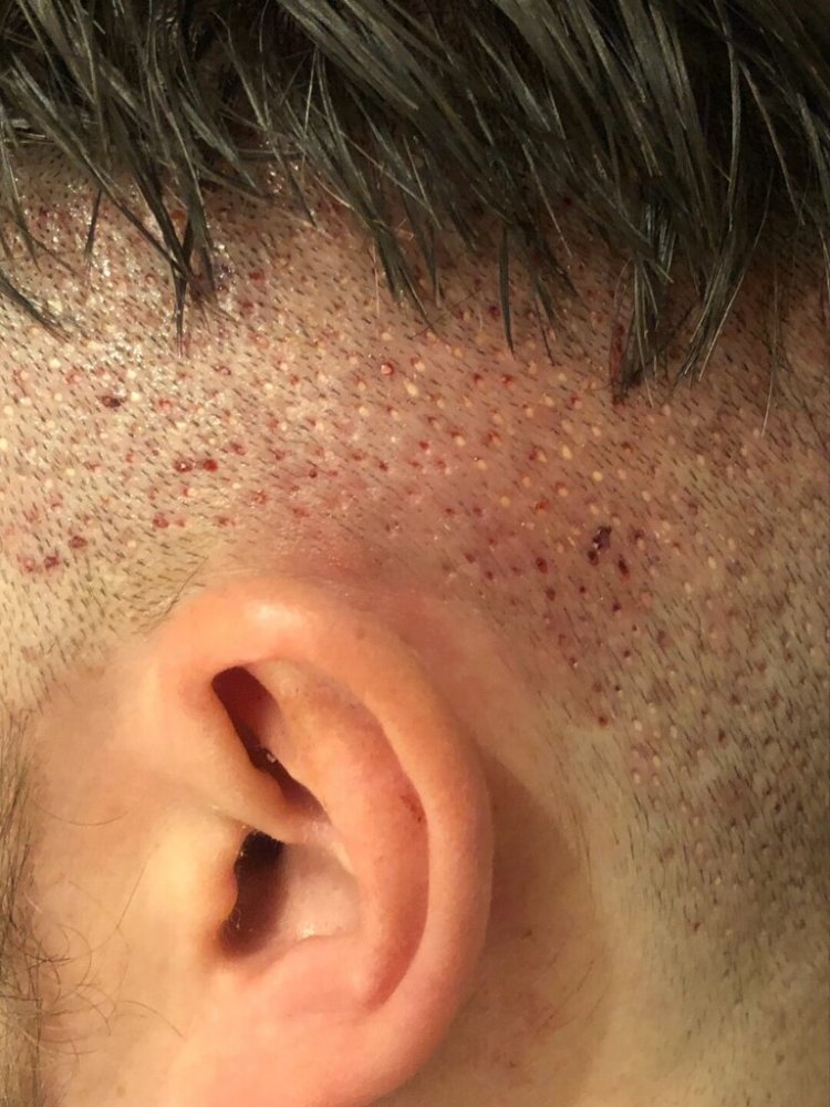 BHR Brussels hair transplant13.jpeg