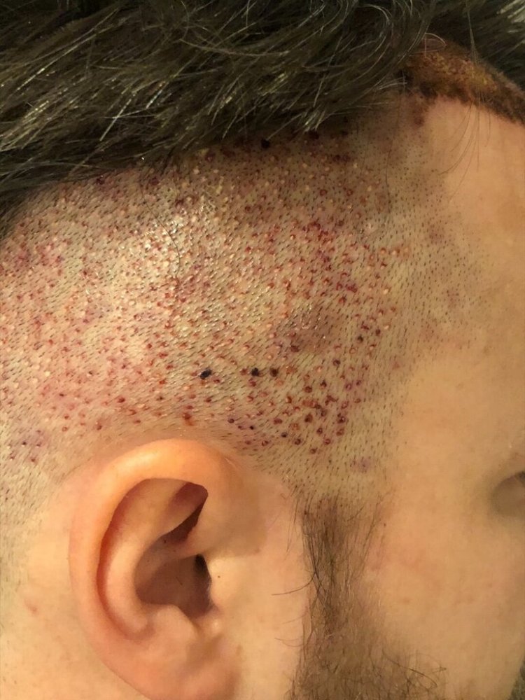 BHR Brussels hair transplant14.jpeg