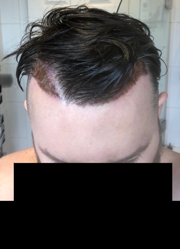 BHR Brussels hair transplant15.jpeg