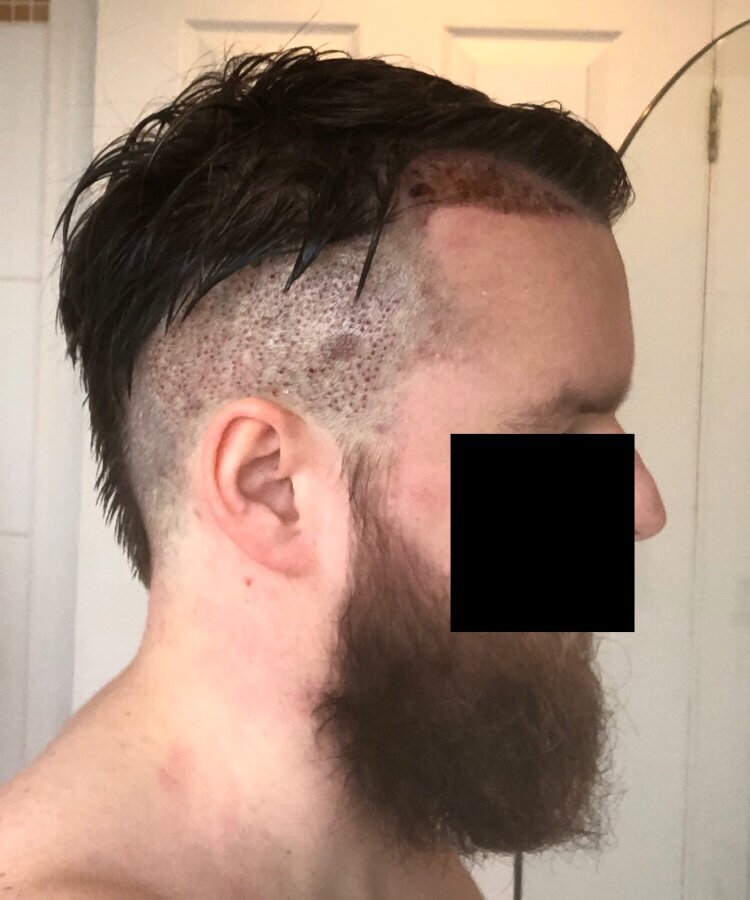 BHR Brussels hair transplant16.jpeg