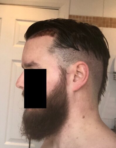 BHR Brussels hair transplant17.jpeg