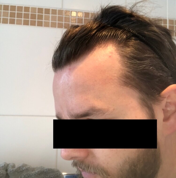 BHR Brussels hair transplant2.jpeg