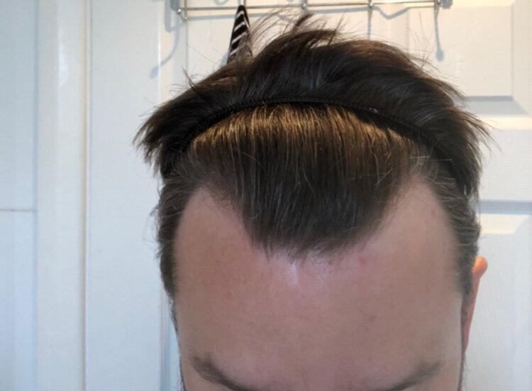 BHR Brussels hair transplant4.jpeg