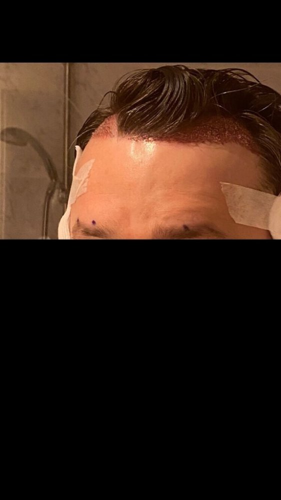 BHR Brussels hair transplant5.jpeg