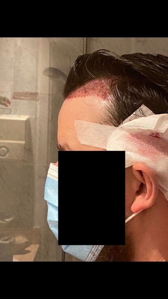 BHR Brussels hair transplant6.jpeg