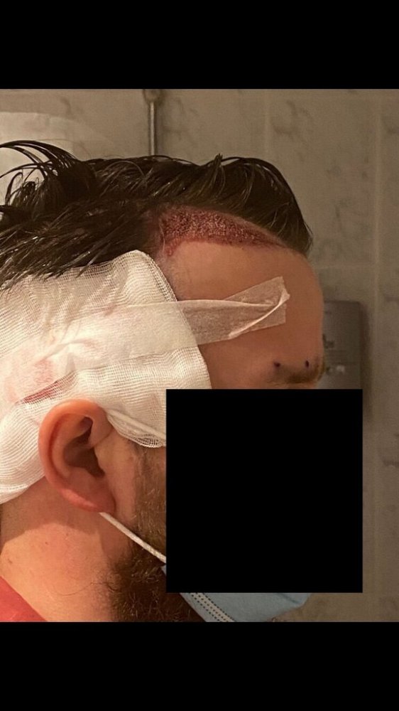 BHR Brussels hair transplant7.jpeg