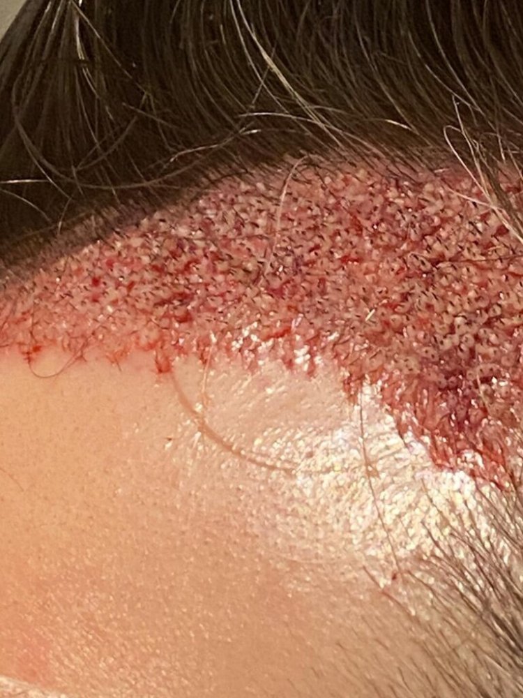 BHR Brussels hair transplant9.jpeg