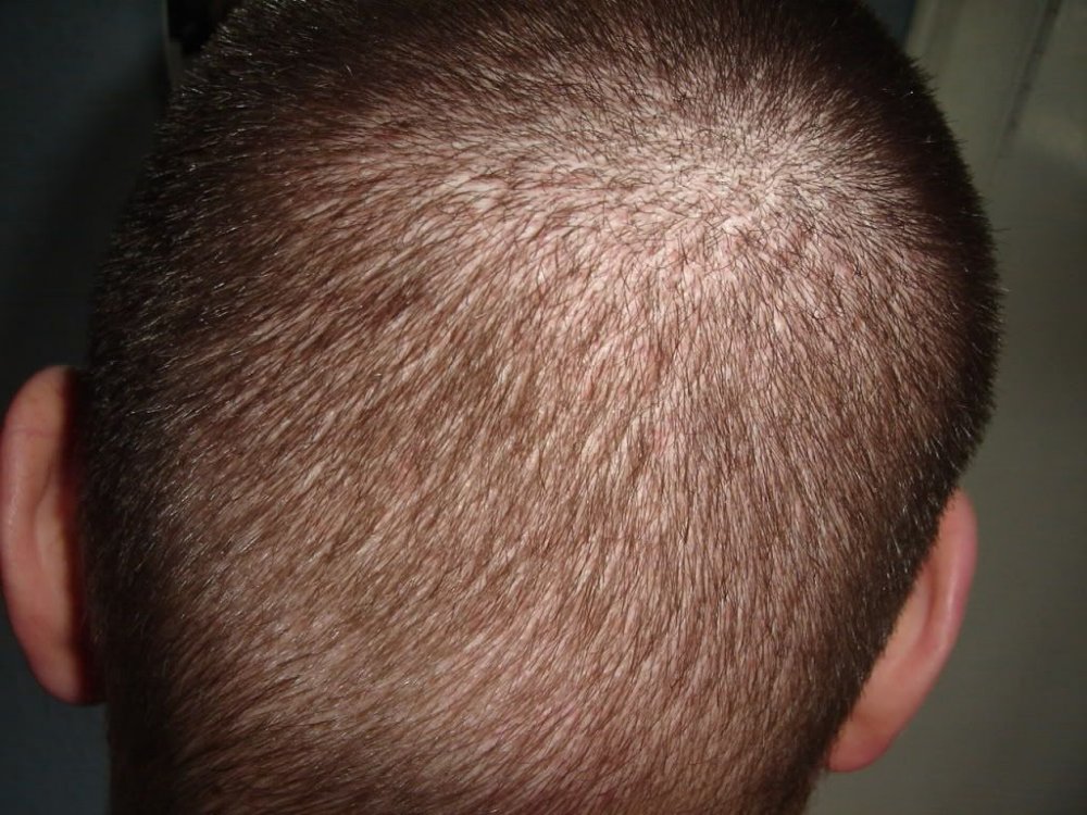 BHR Clinic FUE Hair Transplant - Donor area post-op.jpg