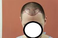 BHR Clinic FUE Hair Transplant1.jpg