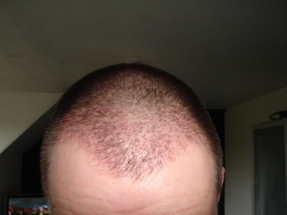 BHR Clinic FUE Hair Transplant1.jpg