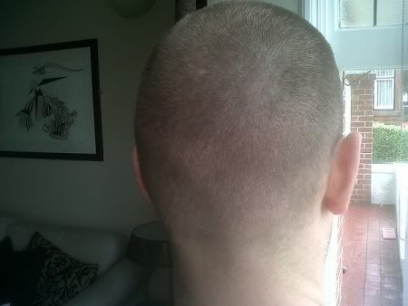 BHR Clinic FUE Hair Transplant10.jpg