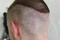 BHR Clinic FUE Hair Transplant2.jpg