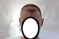 BHR Clinic FUE Hair Transplant3.jpg