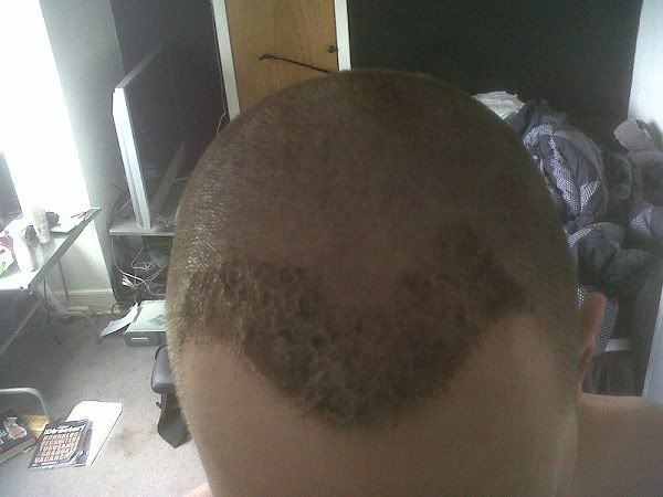 BHR Clinic FUE Hair Transplant4.jpg