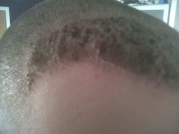 BHR Clinic FUE Hair Transplant5.jpg
