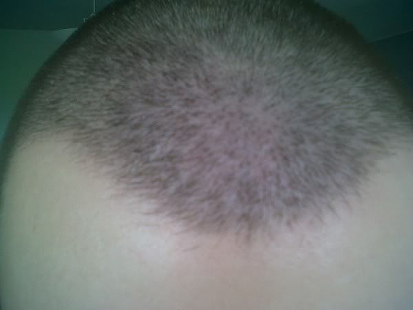 BHR Clinic FUE Hair Transplant7.jpg