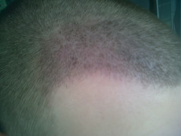 BHR Clinic FUE Hair Transplant8.jpg